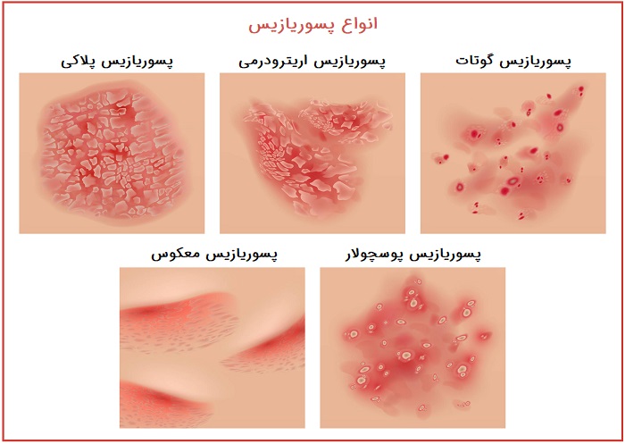 انواع پسوریازیس
