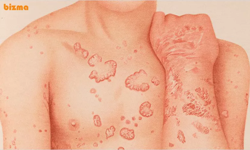 پسوریازیس اریترودرمیک