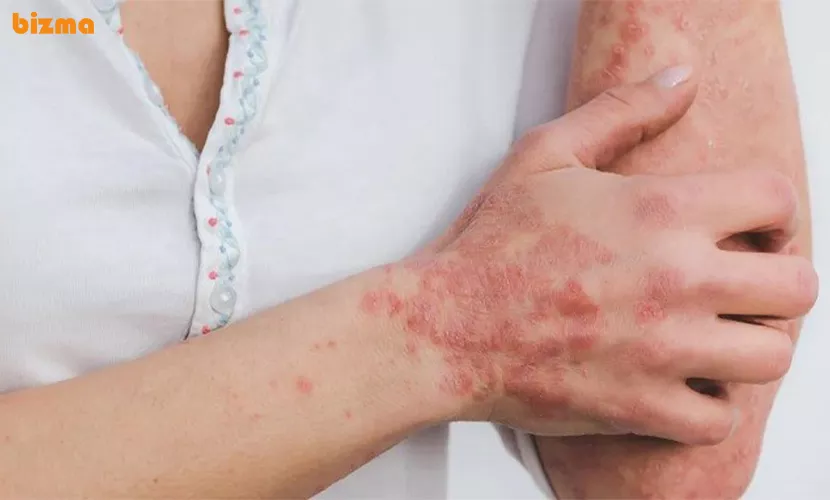 خواص قارچ گانودرما برای پسوریازیس