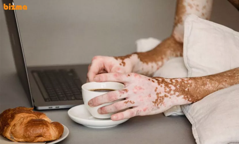 تشخیص بیماری پیسی