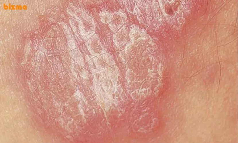 صدف پوستی یا پسوریازیس معکوس