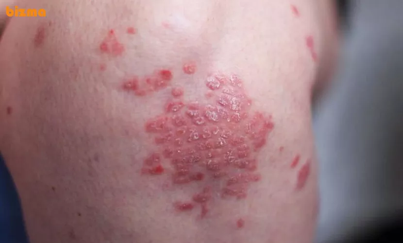 پسوریازیس قطره‌ای یا خالدار