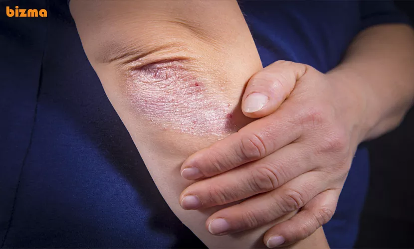 پسوریازیس مفصلی