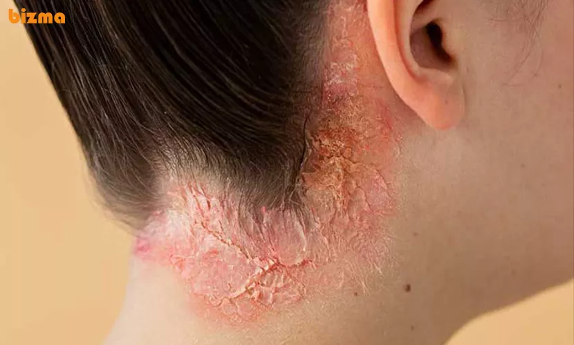 پسوریازیس پوست سر