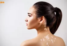 پیسی چیست و چگونه درمان میشود