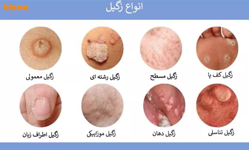 راه های انتقال زگیل تناسلی hpv