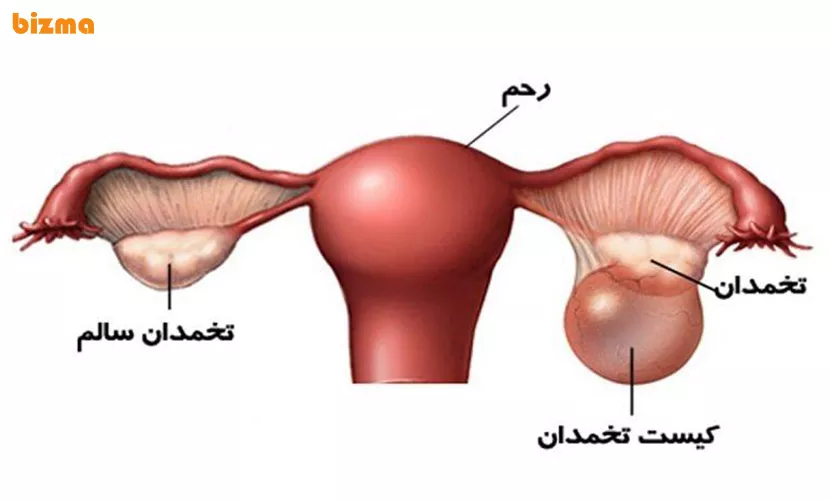 انواع کیست تخمدان