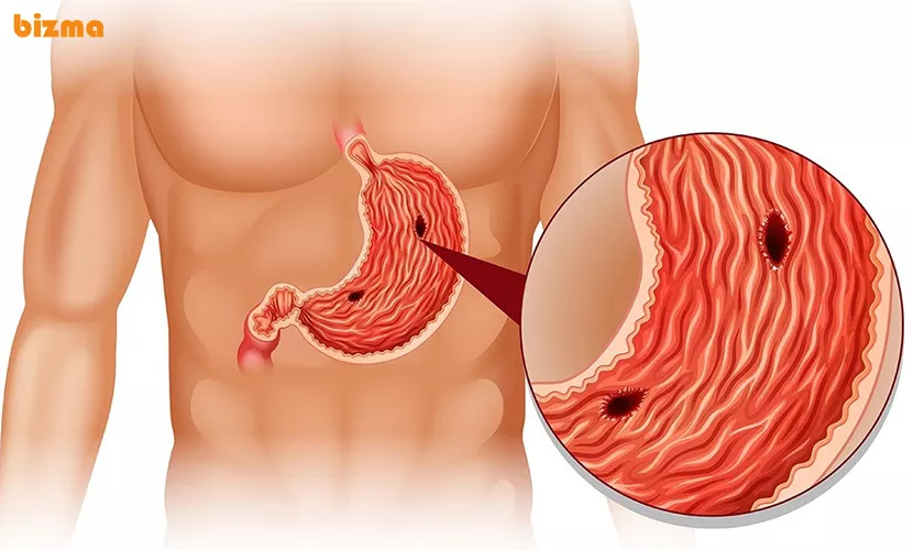 روش‌ تشخیص زخم معده