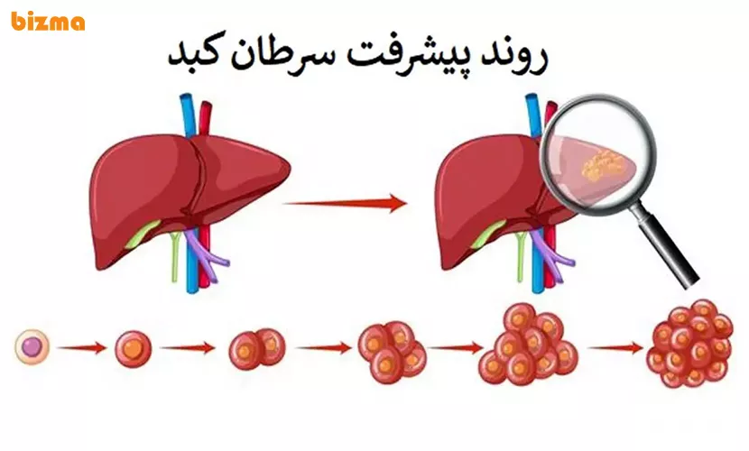 سرطان کبد کشنده است؟ 2 نشانهها و علائم سرطان