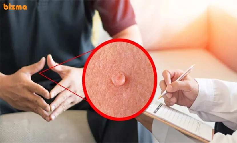 بهترین و موثرترین روش‌های درمان خانگی زگیل تناسلی