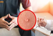 بهترین و موثرترین روش‌های درمان خانگی زگیل تناسلی