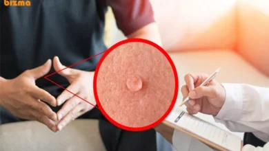 بهترین و موثرترین روش‌های درمان خانگی زگیل تناسلی