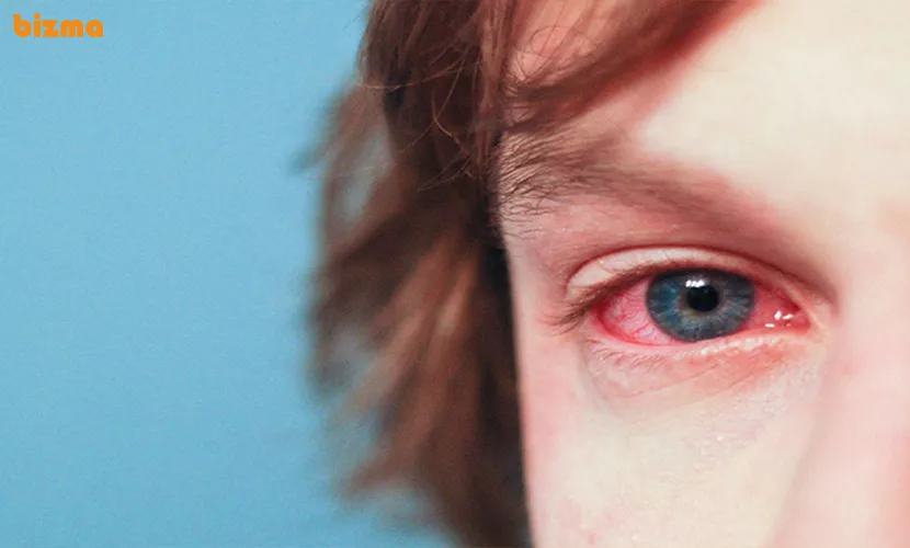 درمان حساسیت فصلی