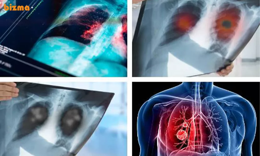 آزمایشات مربوط به تایید و تشخیص علائم سرطان ریه در زنان