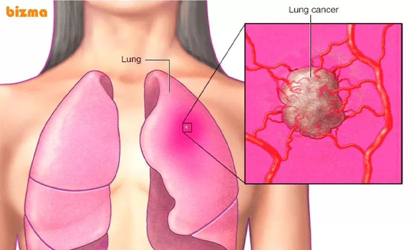 سرطان ریه چیست و چه علائمی دارد؟