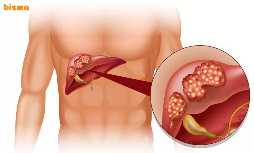 دلایل اصلی بروز سرطان کبد