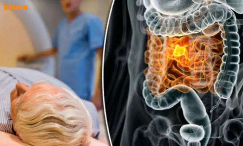 راه های درمان سرطان روده