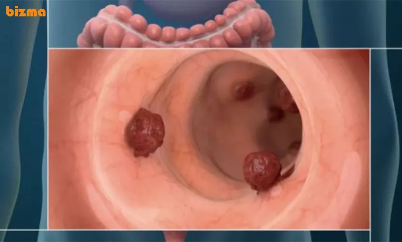 مهم ‌ترین علائم سرطان روده