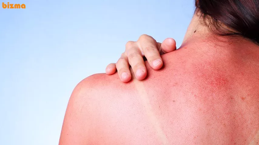 عوارض آفتاب سوختگی شدید؛ درمان سریع خانگی 2 عوارض آفتاب سوختگی شدید چیست؟