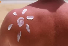 عوارض آفتاب سوختگی چیست؟ درجات مختلف آفتاب سوختگی