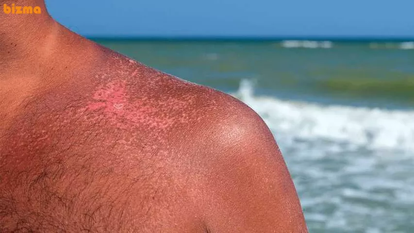 درمان عوارض آفتاب سوختگی شدید