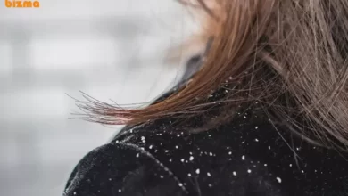 برای جلوگیری از شوره سر چکار باید کرد + درمان قطعی و خانگی