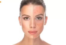 درمان تیرگی پوست دلایل تیره شدن پوست صورت و بدن درمان تیرگی زیربغل و کشاله ران