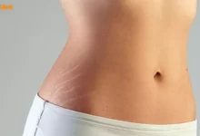 درمان خانگی استرچ مارک و راه های رفع ترک پوستی