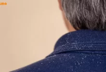 بهترین شامپو ضد شوره و خارش سر