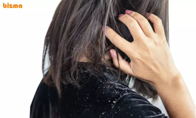 علت شوره سر