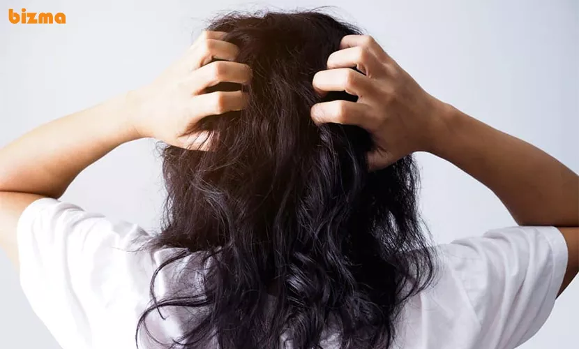 انواع شوره سر