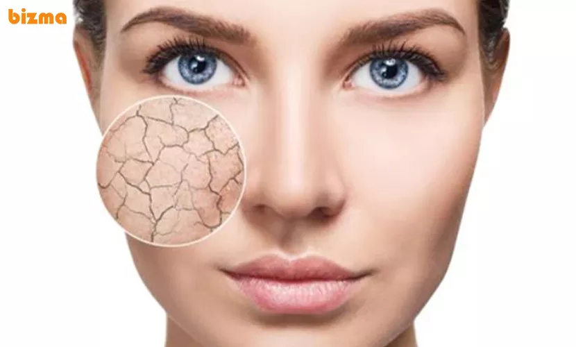 درمان خانگی خشکی پوست