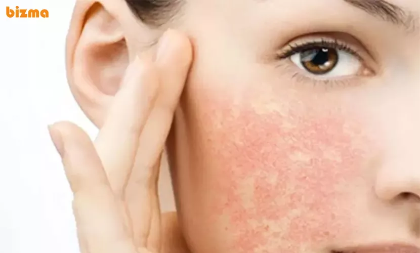 عوارض خشک شدن پوست صورت