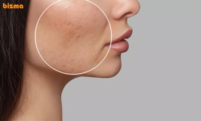 درمان منافذ باز پوست صورت با کنترل چربی