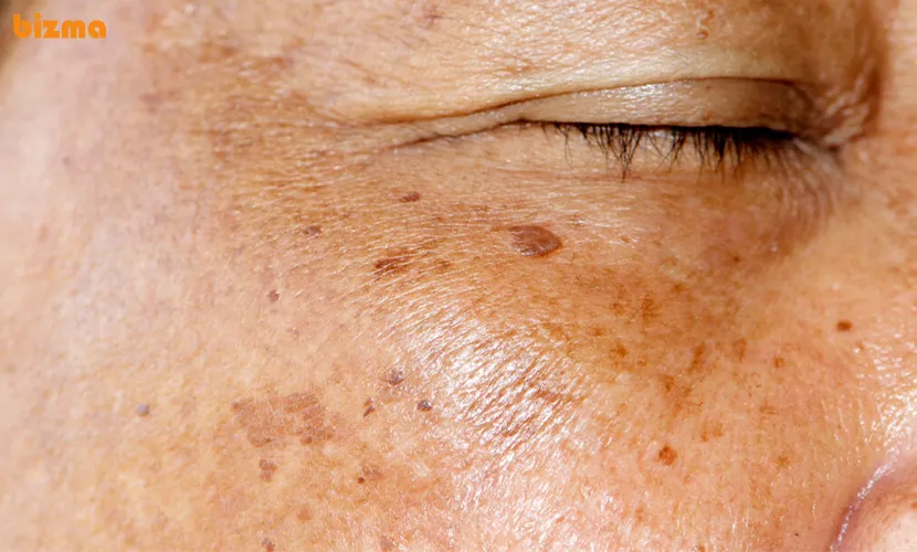 ماسک خانگی ضد لک و ضد جوش