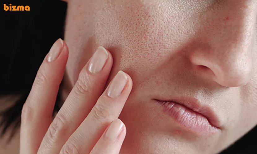 دلایل باز شدن منافذ پوست صورت
