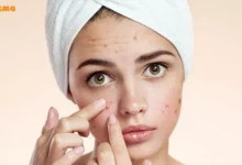 انواع آکنه و روش های تصمینی درمان آکنه و جوش