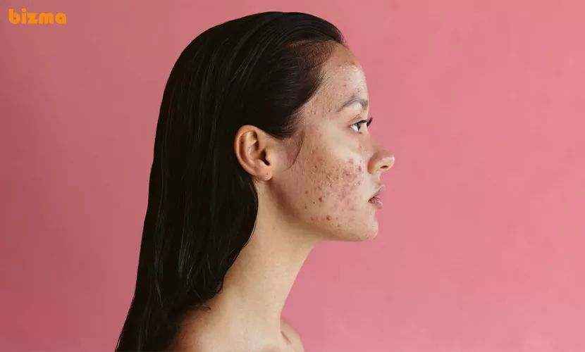 درمان جای لک ناشی از جوش